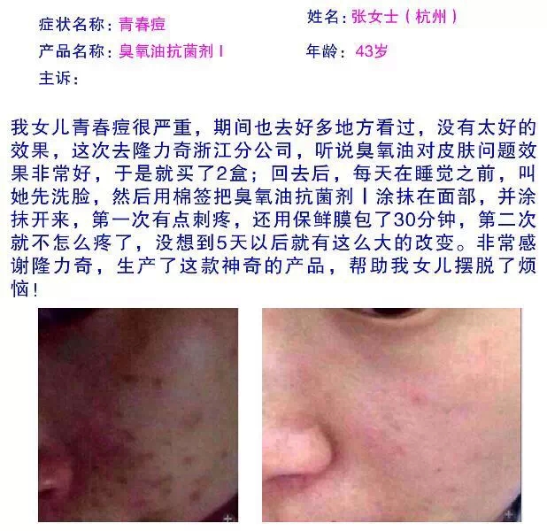 隆力奇臭氧油抗菌剂 隆力奇臭氧油抗菌剂
